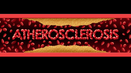 atherosclerosis